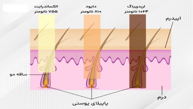 لیزر الکس دایود در مقایسه با سایر لیزرها