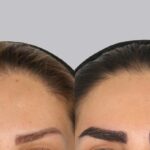 کاشت ابرو بدون بیهوشی؛ زیبایی طبیعی همراه با راحتی بیشتر