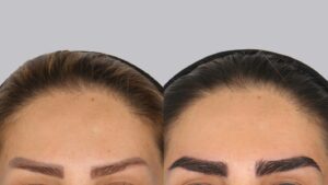 کاشت ابرو بدون بیهوشی؛ زیبایی طبیعی همراه با راحتی بیشتر
