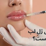 تزریق ژل لب