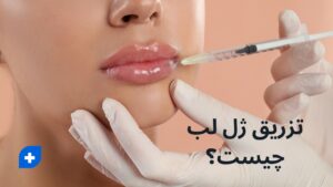 تزریق ژل لب