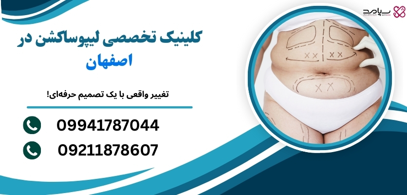 لیپوساکشن شکم در اصفهان