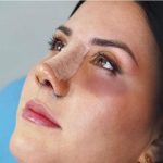 علت ورم و کبودی بعد از عمل بینی