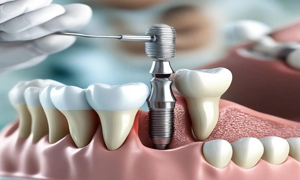 Choosing the right dental implant