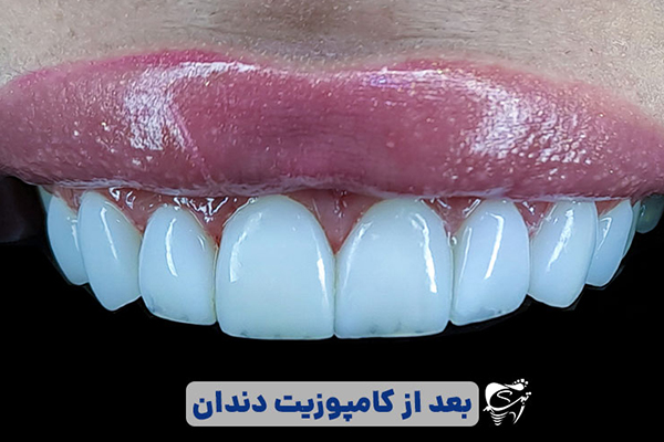 نمونه کامپوزیت دندان در شیراز