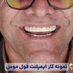 نمونه ایمپلنت دندان در شیراز