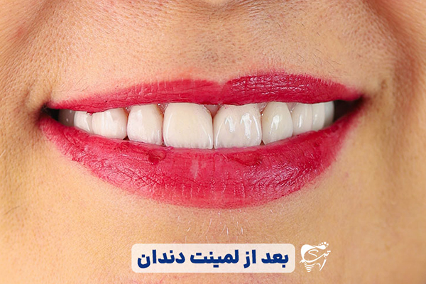 نمونه لمینت دندان در شیراز