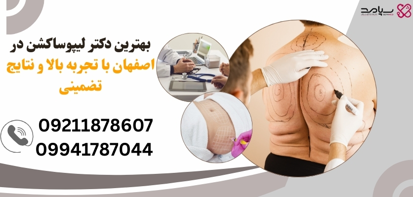 لیپوساکشن پهلو در اصفهان