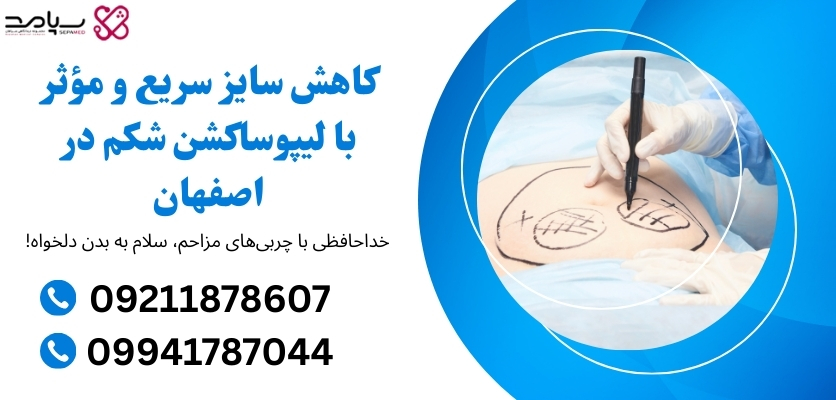 بهترین روش لیپوساکشن شکم در اصفهان