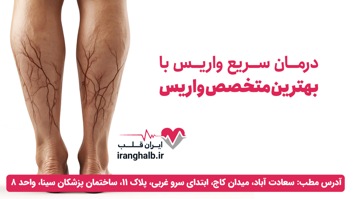 درمان واریس