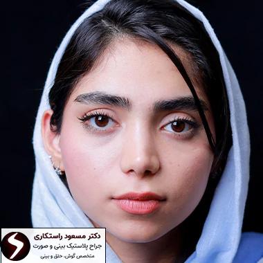 نتیجه عمل زیبایی بینی