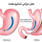 عمل اسلیو معده چیست و چگونه باعث لاغری می‌شود؟