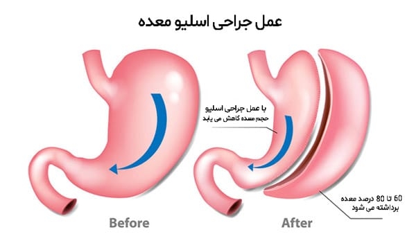 با عمل اسلیو معده به وزن ایده آل برسید؛ همه چیز درباره مزایا، هزینه و دوران نقاهت