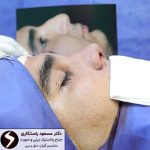 چطور بینی‌مان را متناسب با فرم صورت انتخاب کنیم؟ راهنمای انتخاب فرم بینی طبیعی