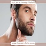 کاشت ریش