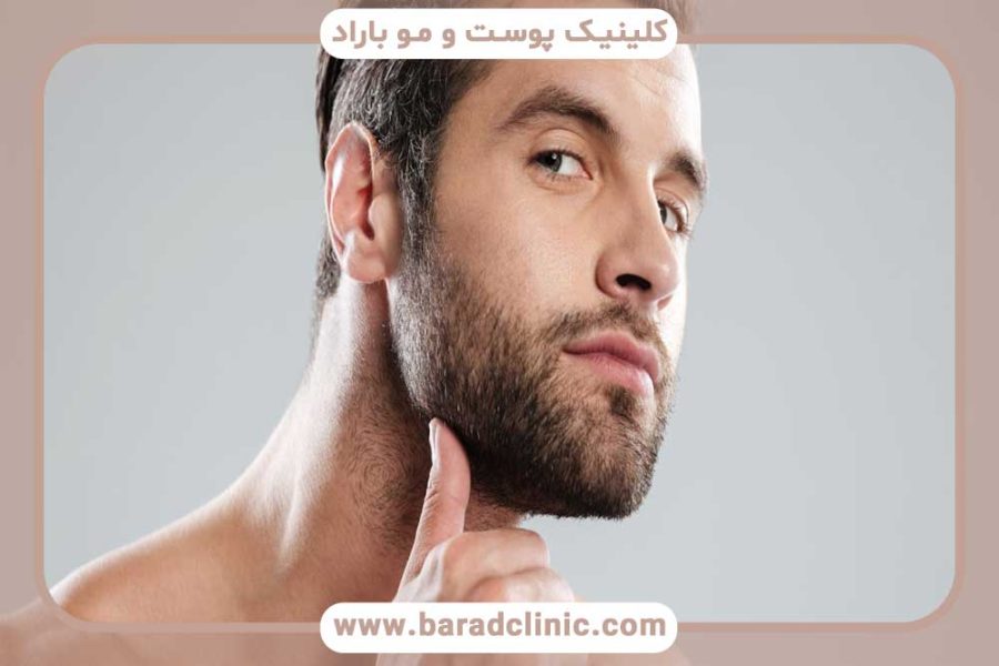کاشت ریش