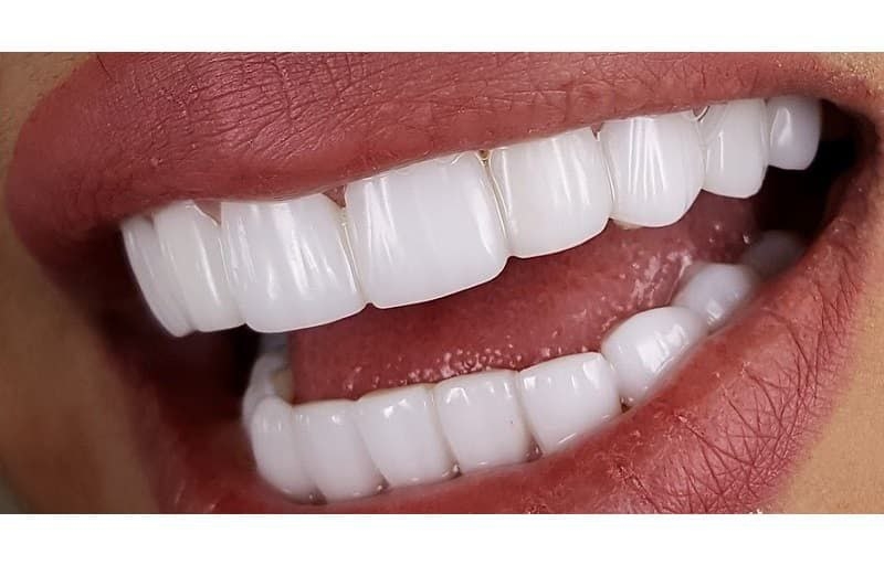 لمینت پرسلن یا لمینت سرامیکی؟ کدام بهتر است؟ مقایسه لمینت پرسلن و لمینت کامپوزیتی