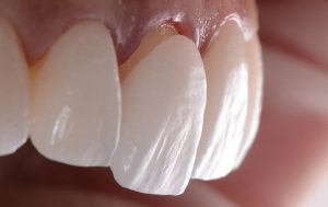 لمینت پرسلن یا لمینت سرامیکی؟ کدام بهتر است؟