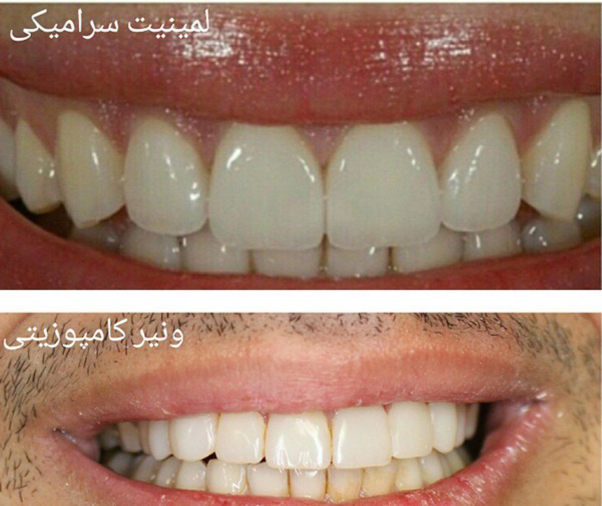 لمینت پرسلن یا لمینت سرامیکی؟ کدام بهتر است؟ لمینت پرسلن چیست؟