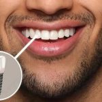 وقتی کیفیت جهانی ایمپلنت را با قیمت مناسب تجربه می‌کنید