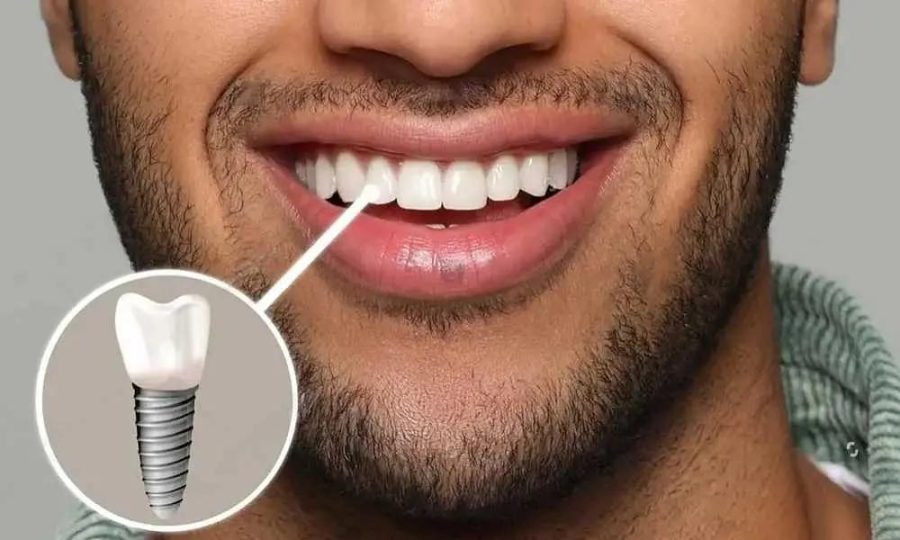 وقتی کیفیت جهانی ایمپلنت را با قیمت مناسب تجربه می‌کنید