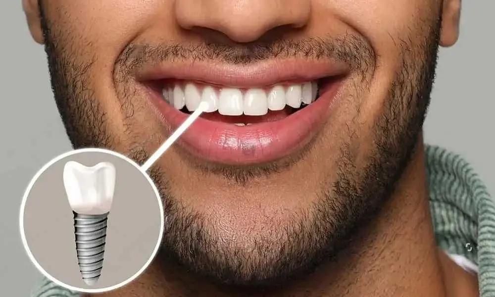 دکتر قادری : وقتی کیفیت جهانی ایمپلنت را با قیمت مناسب تجربه می‌کنید