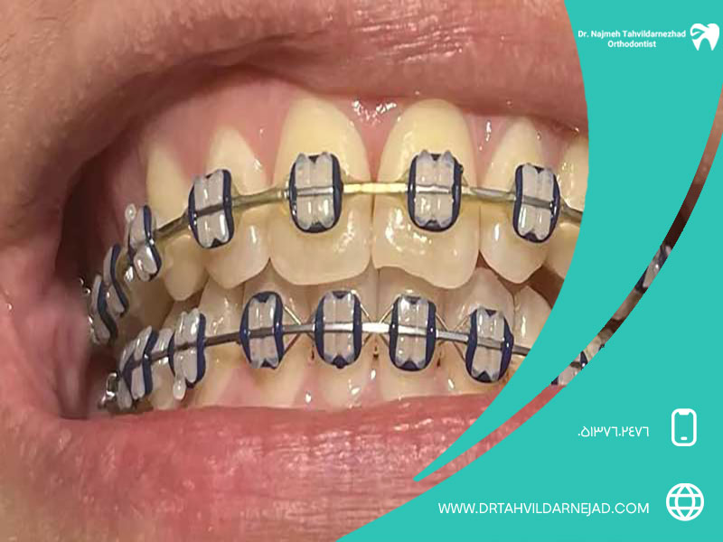 راهکارهای جلوگیری از زردی دندان در ارتودنسی