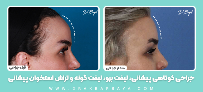 بهترین جراح کوتاه کردن پیشانی در تهران