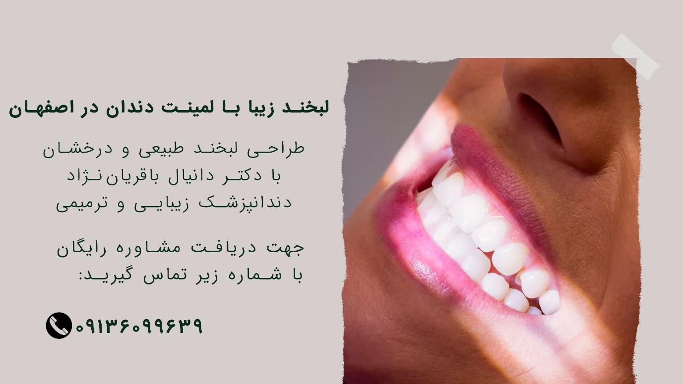 لمینت دندان طرح لبخند در اصفهان اصلاح لبخند در مطب دکتر باقریان نژاد