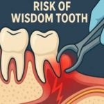 عوارض جراحی دندان عقل نهفته روی عصب