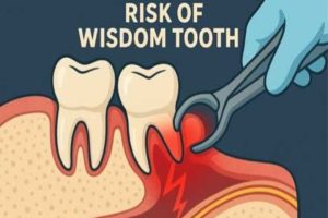 عوارض جراحی دندان عقل نهفته روی عصب