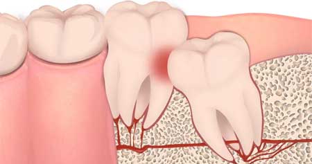 عوارض جراحی دندان عقل نهفته روی عصب