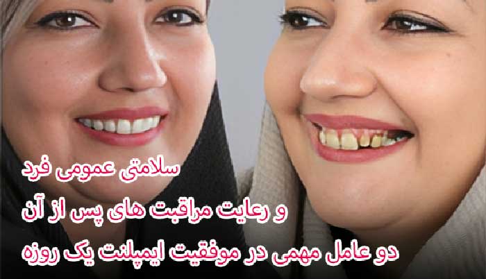 ایمپلنت فوری یک روزه دیجیتالی چیست؟ آیا همهی افراد میتوانند از ایمپلنت فوری استفاده کنند؟