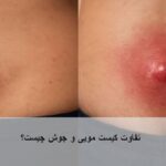 تفاوت کیست مویی و جوش
