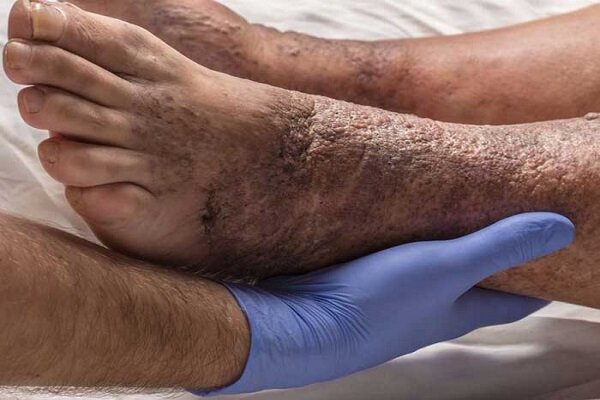 بی‌دردی زخم در افراد دیابتی نشانه پیشرفت آسیب عصبی است