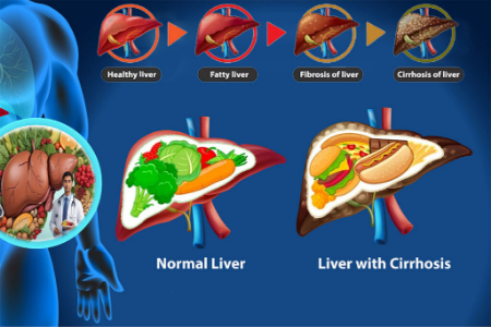 رژیم غذایی سیروز کبدی؛ برنامه کامل ۷ روزه + غذاهای ممنوعه و مجاز