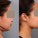 ساکشن غبغب چیست؟ صفر تا صد یک عمل ۴۵ دقیقه‌ای که خط فک را برمی‌گرداند