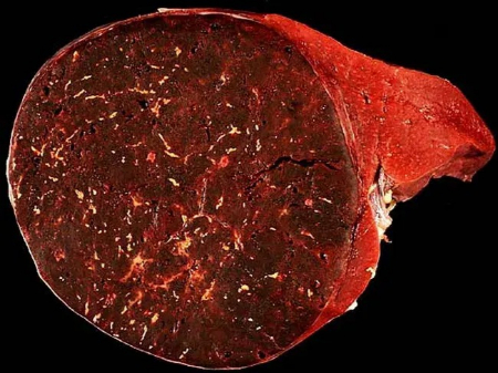 هامارتوما, تومور خوش خیم ریه