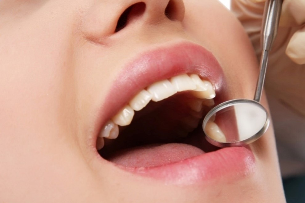 آیا کامپوزیت باعث پوسیدگی دندان میشود؟ (بررسی علمی + راهکارها)