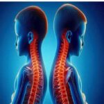 اسکولیوز تهدید خاموش ستون فقرات کودکان است؛ از هر ۲۰ نفر یک مبتلا
