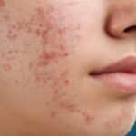 درمان جدید آکنه از راه رسید
