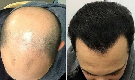 هزینه کاشت مو در شهر های مختلف ایران