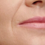 چاره چروک دور لب ها چیست؟