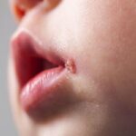 تفاوت آفت و تبخال در کودکان