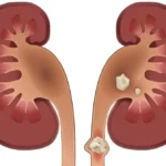 سنگ کلیه چه علائمی دارد؟