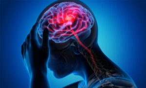 تحریک نخاع به بازیابی قدرت بازو پس از سکته مغزی کمک می کند