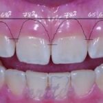 جراحی لثه برای افزایش طول تاج درد دارد؟