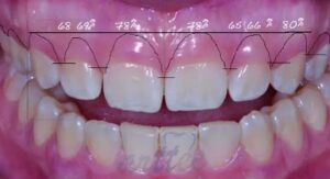 جراحی لثه برای افزایش طول تاج درد دارد؟