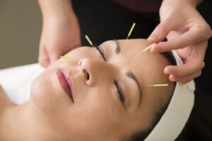 درد میگرن پس از انجام طب سوزنی روی گوش کاهش می یابد!