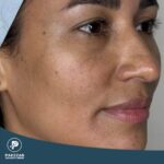 عکس صورت زنی که از خدمات جوانسازی استفاده کرده است